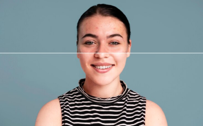 Food Hacks to Get Rid of Acne